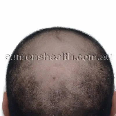 Introduction to Alopecia: Understanding Hair Loss Issues